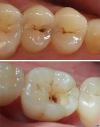 牙膏减少牙渍牙结石,去除牙菌斑清新口气牙膏