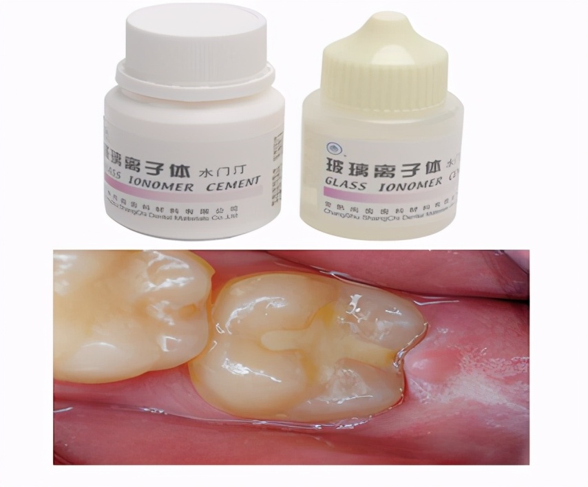 600补一颗牙齿贵吗,诊所补一颗牙多少钱