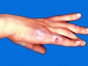 53岁王大姐，手脚红肿确诊冻疮，经及时治疗，两周治愈