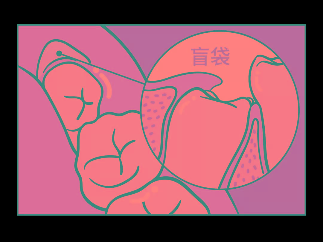 智齿剩一个牙根了不好拔用开刀么,智齿拖着不拔的人有的截骨了