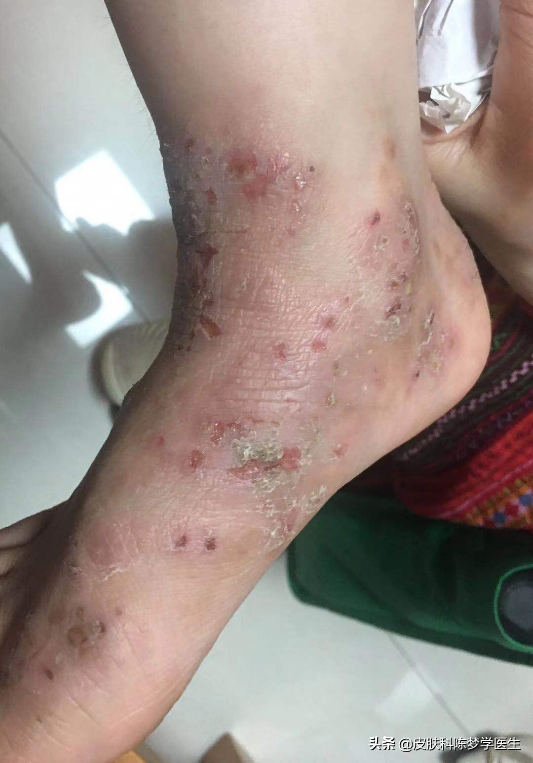 皲裂性湿疹怎么治,湿疹能不能治得好