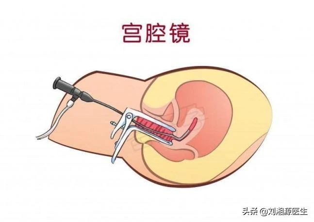 「免疫相关不良妊娠答疑解惑39」——子宫内膜炎