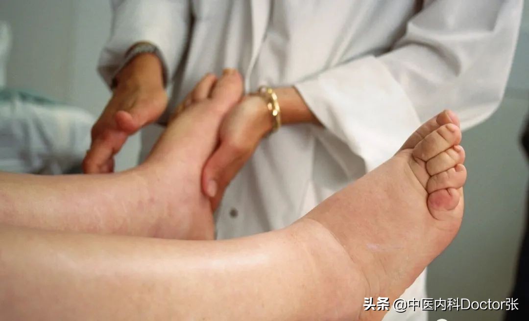 老人双脚水肿怎么治疗,老年人脚水肿怎么治疗最快最有效