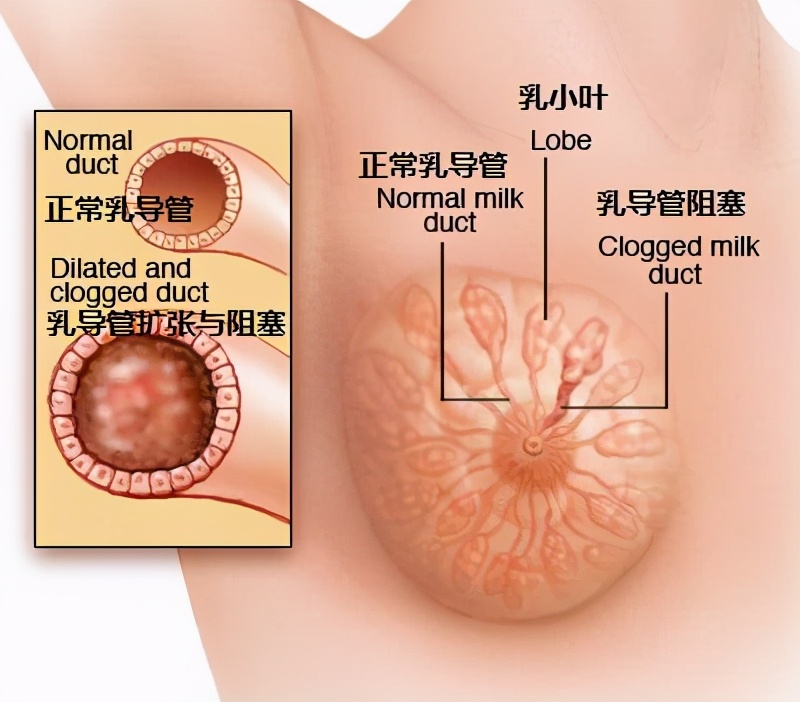 乳腺增生及导管扩张该如何治疗,乳腺导管扩张用中医调理有效果吗