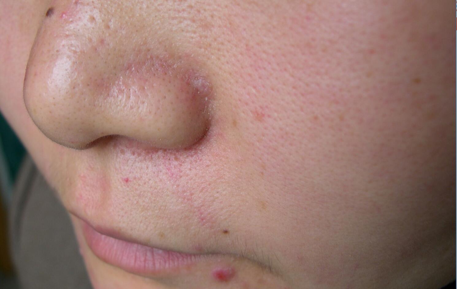 脂溢性皮炎患者怎么保护皮肤,脂溢性皮炎发展到皮肤病了怎么办