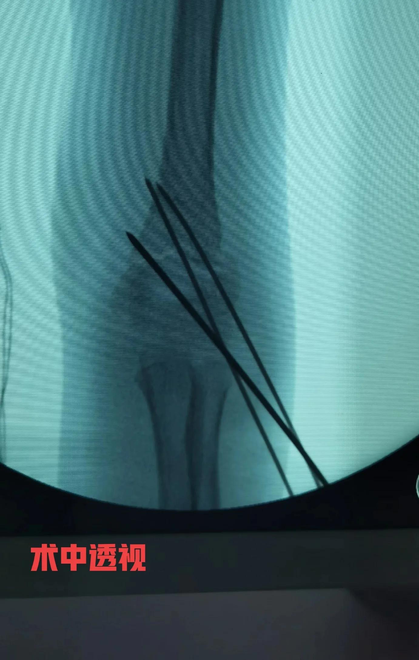 肱骨髁上骨折手法复位图,肱骨髁上骨折克氏针固定