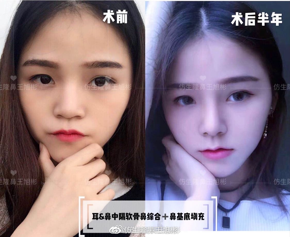 鼻整形最简易方法,鼻孔又大又塌又朝天鼻整形