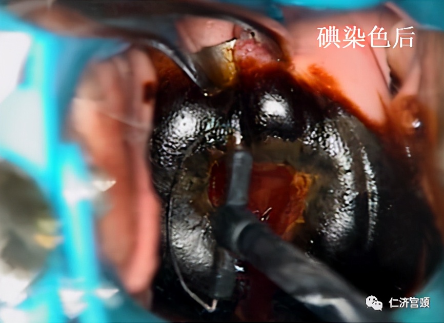 leep手术疼吗,leep手术后出血多久