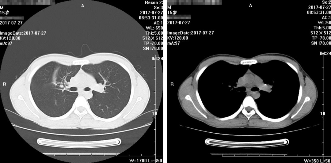 如何在CAP初始治疗后72h内进行病情评价？其成功关键有哪些？
