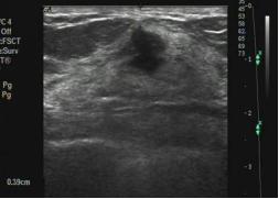 乳腺恶性肿瘤彩超表现,乳腺结节良性恶性彩超对照图