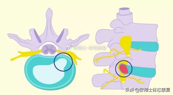 运动康复腰突训练,颈椎间盘突出怎么锻炼才能康复