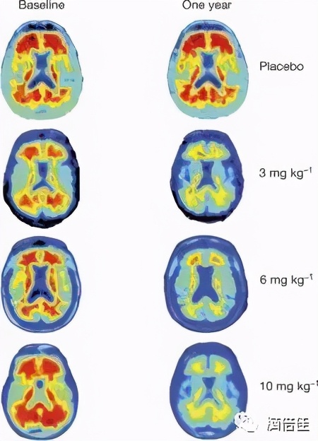 「全浸英语阅读」AlzheimersDisease阿兹海默症的微光