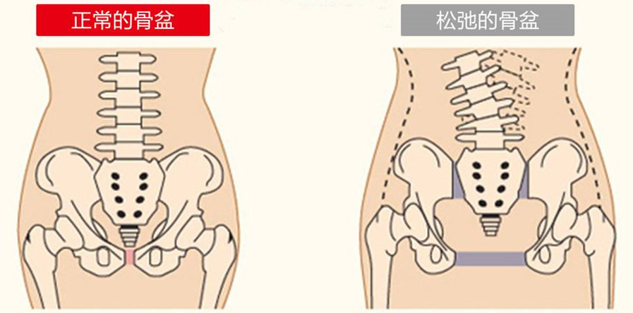骨科专家女性腰痛,孕妇为啥老是觉得腰痛