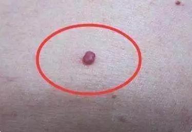 出现痣警惕肝脏病变,肝痣是肝脏发出的求救信号