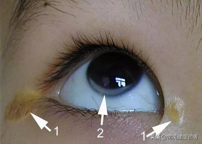 得了高胆固醇血症怎么办,高胆固醇血症有五个表现症状