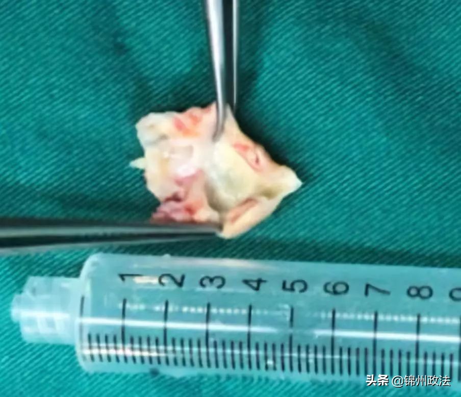 男子体内抽出2升油脂,男子体内取出一升油脂