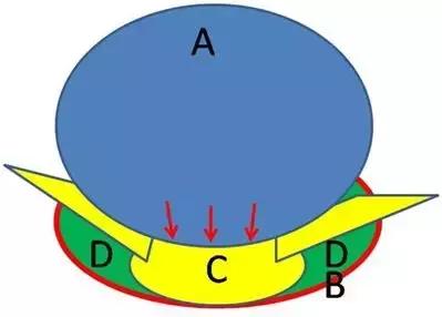 椎间盘膨出硬膜囊受压严重吗,磁共振检查颈椎膨出硬膜囊受压