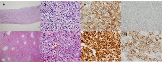 髓样肉瘤,髓系肉瘤合并髓系白血病