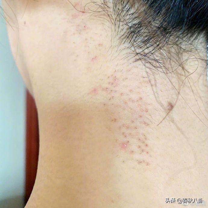 杨紫剃碎发,杨紫整容还能恢复吗