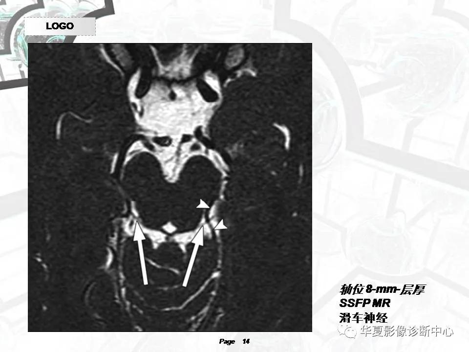 磁共振颅神经扫描是定位在哪,颅神经图谱
