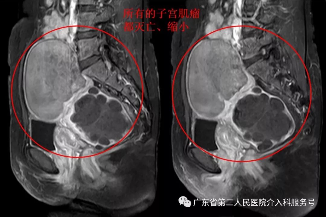多发子宫肌瘤浆膜下,浆膜下多发子宫肌瘤怎么办