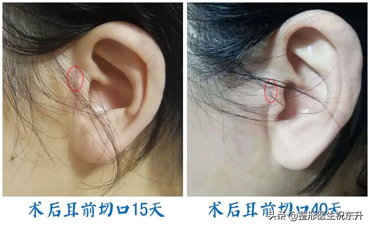 拉皮手术后的疤痕处怎么修复,腹部拉皮手术能去除剖腹产的疤吗