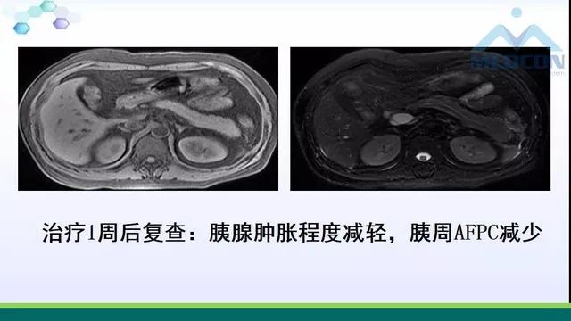 急性胰腺炎的护理措施,急性胰腺炎影像与临床