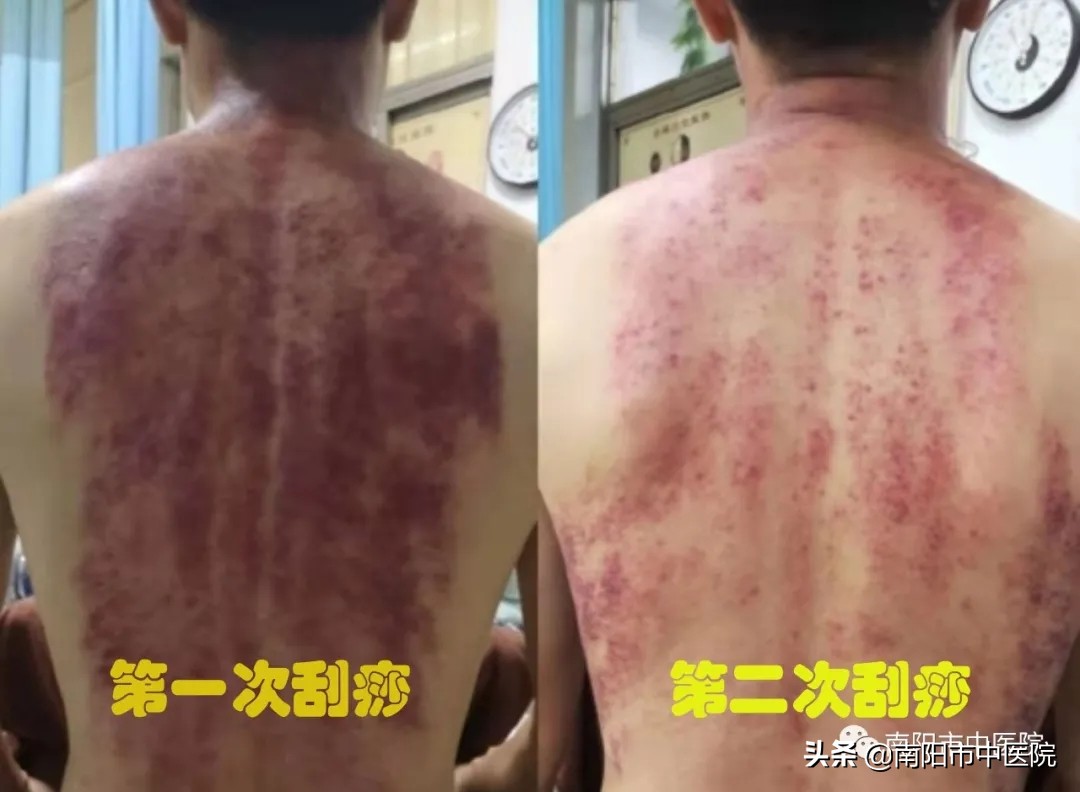 南阳市中医院开展多种中医特点治疗项目——虎符铜砭刮痧