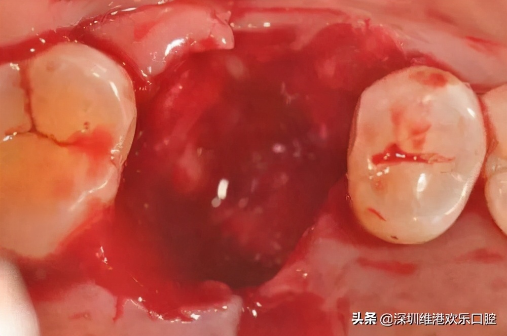 智齿拔牙全过程痛苦,拔智齿后干槽症可以自愈吗