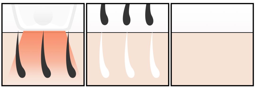 网红脱毛仪到底怎么样,脱毛仪网红都推荐什么牌子