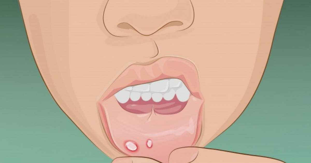 嘴上起泡怎么消除,嘴上起泡什么原因怎么消除