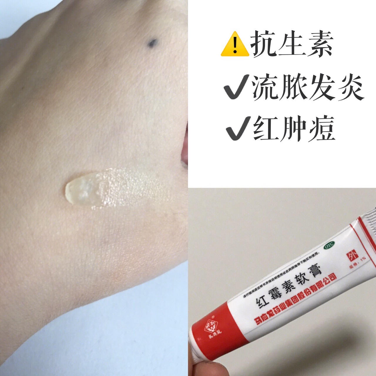 女孩子必用的祛痘神器,公认最好的祛痘药