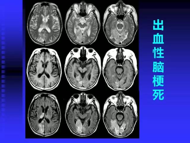 头颅mri读片视频教程,颅脑mri读片入门教程视频讲解全集