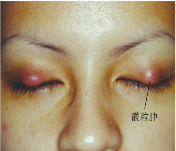 小孩麦粒肿和霰粒肿的区别,霰粒肿和麦粒肿是一样的吗