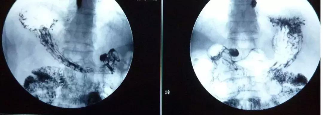 胶囊胃镜再也不用忍受插管的痛苦,插管胃镜和无痛胃镜哪种最好