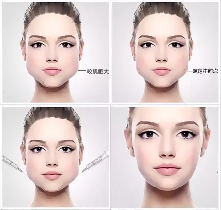 怎么才知道自己适不适合打瘦脸针,什么脸型不建议打瘦脸针