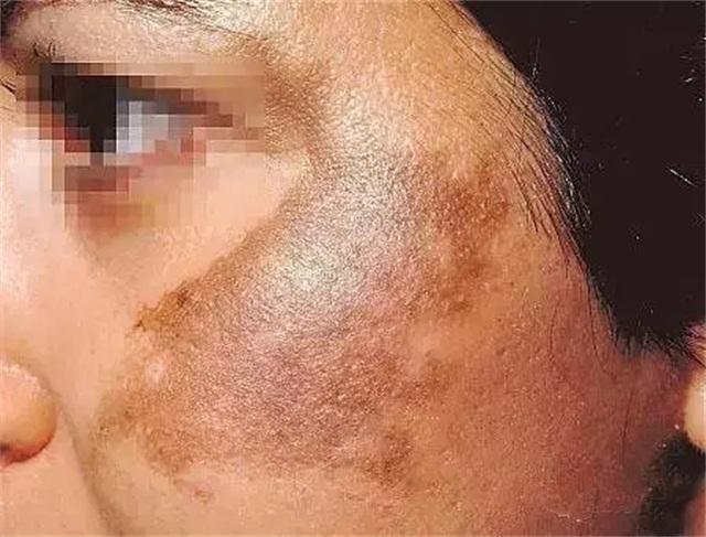 常见的色斑种类图文,脸部常见斑种类及图片