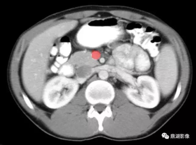 颈部胸锁乳突肌ct断层解剖图,骨盆骨质正常断层ct解剖图解
