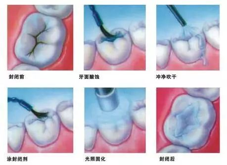 helen齿科中心超声波洁牙的步骤,helen齿科中心牙齿保健小贴士