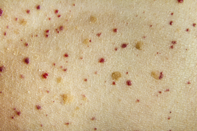 怎么祛痣不留疤痕的最好方法,脸祛痣的最好方法不留疤