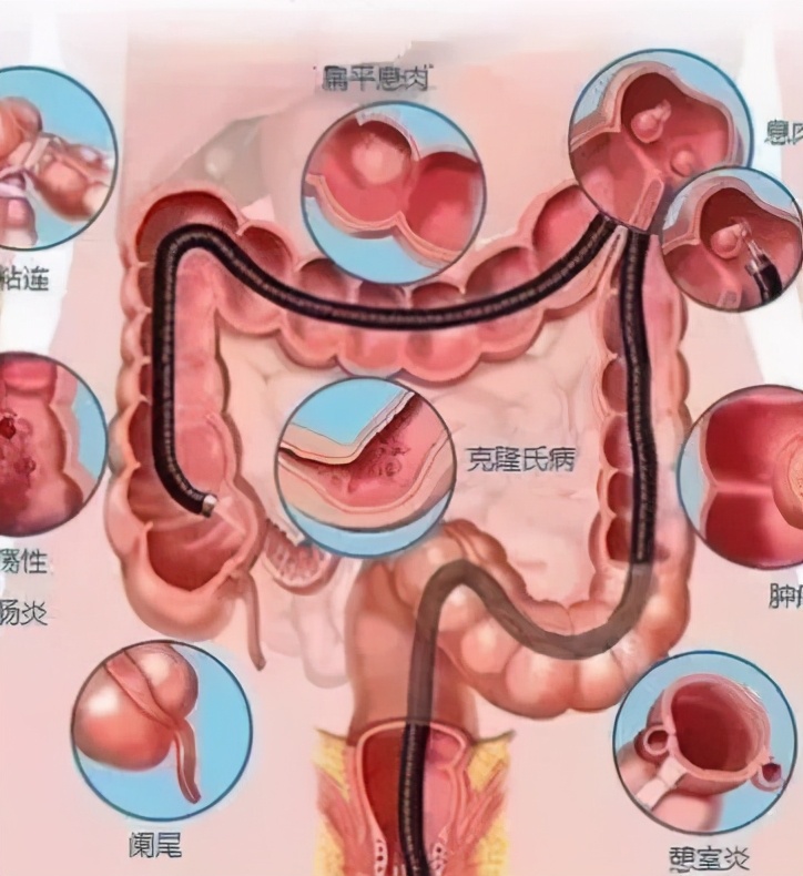 黑斑息肉综合征有什么症状,黑斑息肉综合征临床表现