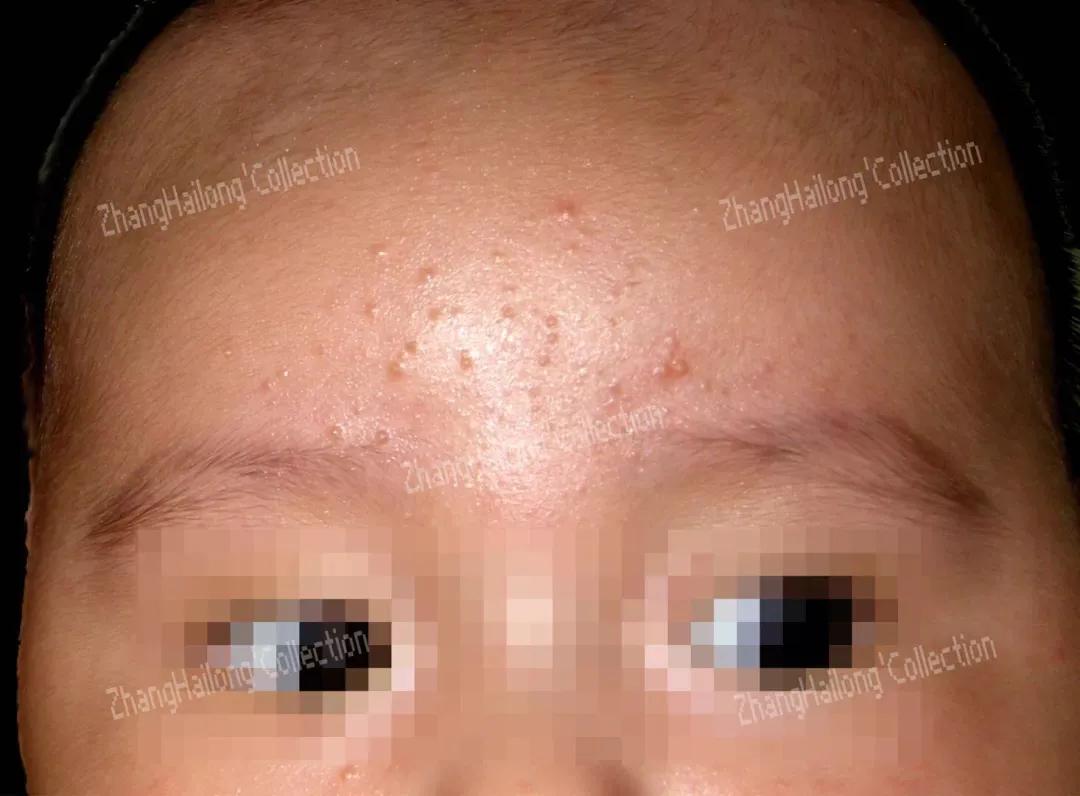 新生儿青春痘,小孩长青春痘怎么办