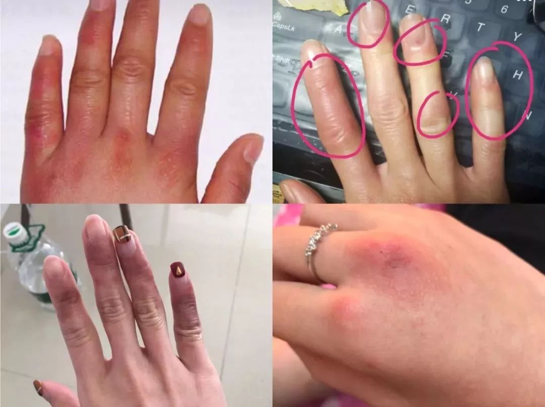 冬季皲裂膏预防脚后跟干裂好用的,上热门脚后跟干裂保湿霜