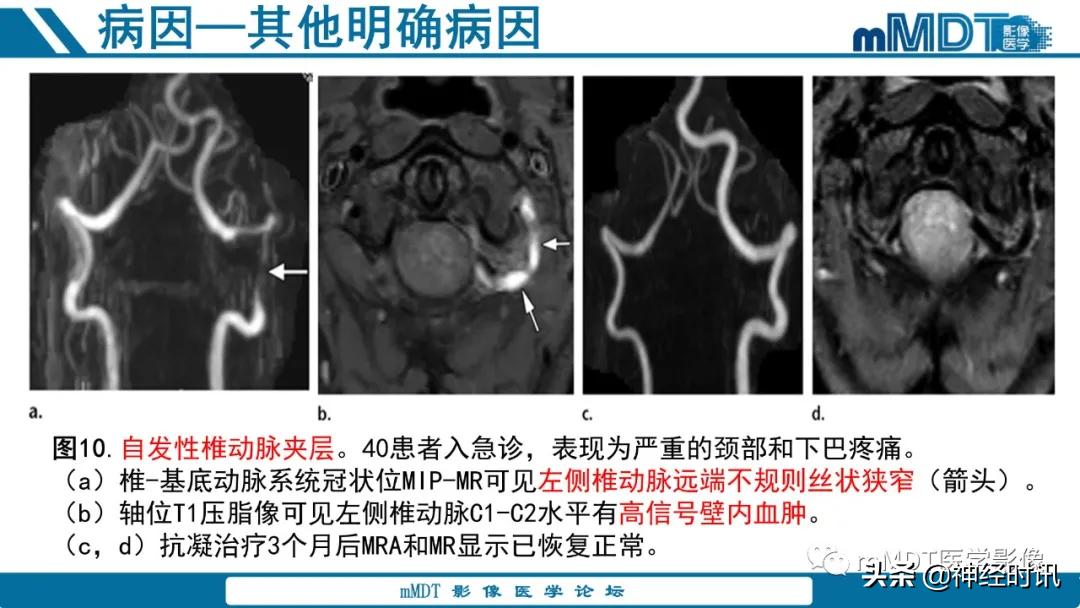 缺血性脑卒中护理课件,缺血性脑卒中讲课ppt