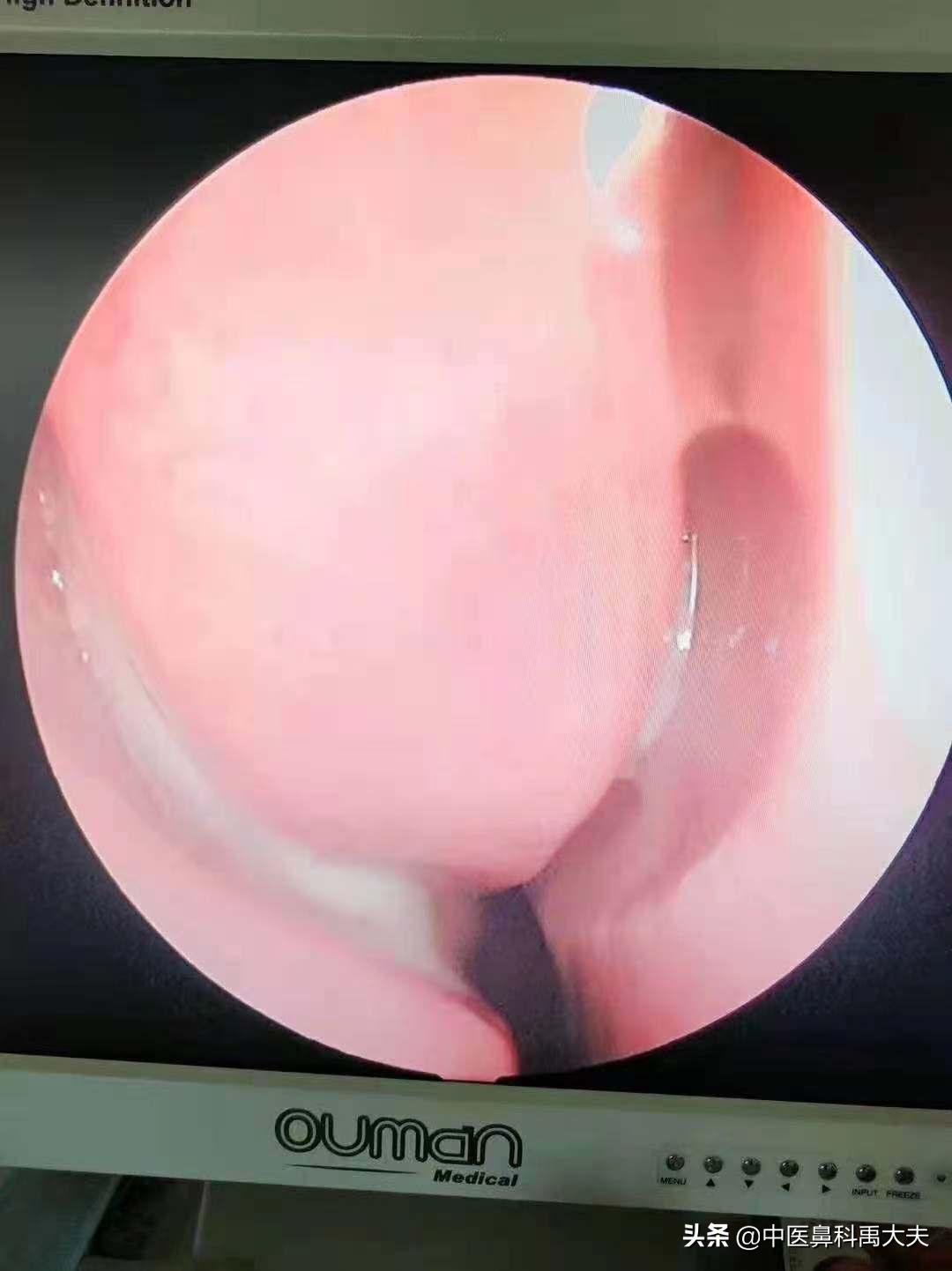 儿童上颌窦炎前额痛怎么缓解,上颌窦炎面颊部疼痛需要手术吗