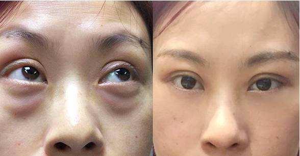 卧蚕和眼袋的区别你知道吗,眼袋和卧蚕的区别在哪里