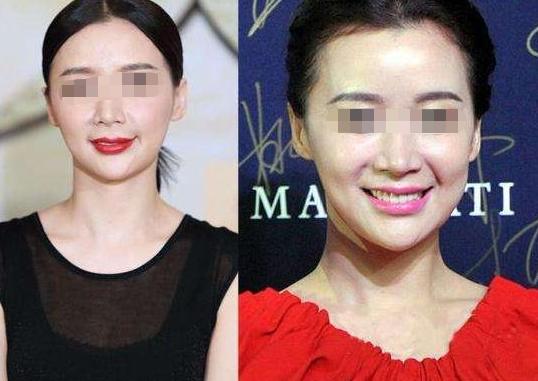 打瘦脸针3次真的可以永久定型吗,瘦脸针打三次真的能定型么