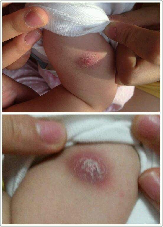 宝宝胳膊上长了密密的小疙瘩,宝宝胳膊内有个小疙瘩是什么原因