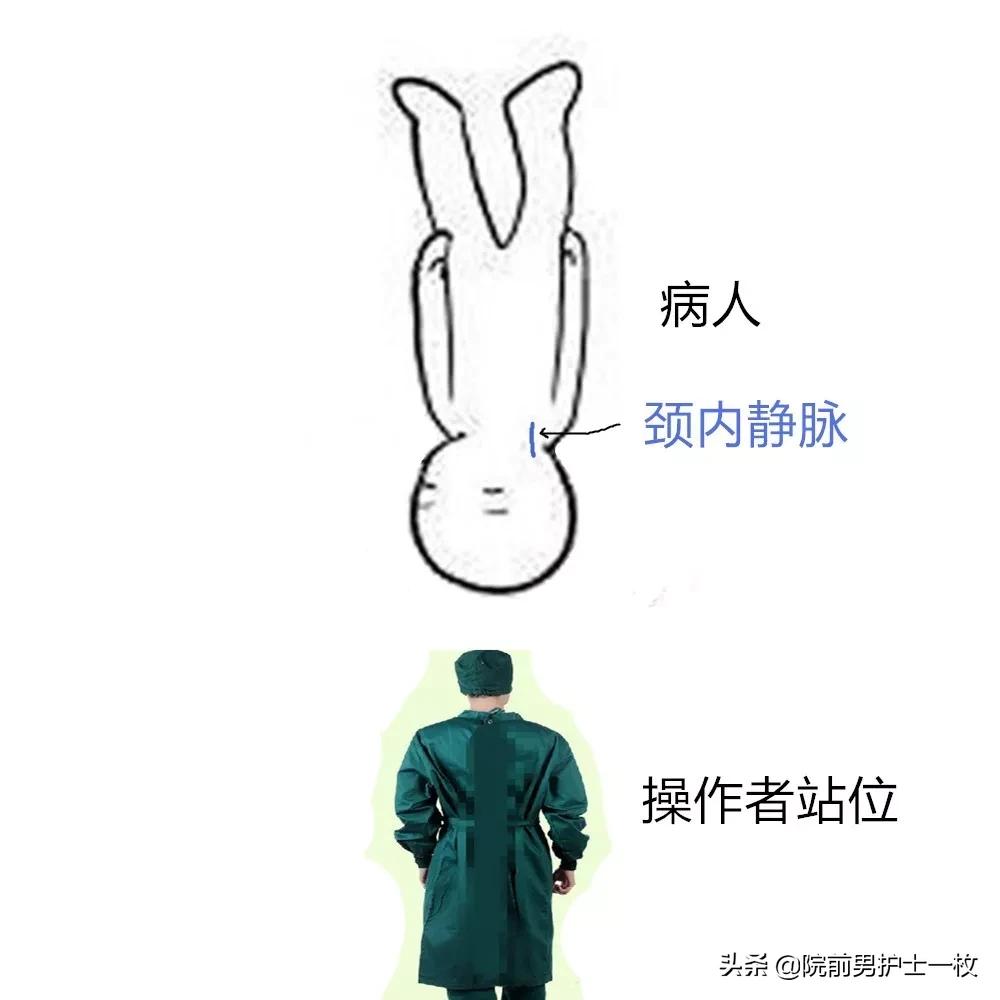 深静脉置管锁骨下静脉穿刺部位,深静脉穿刺置管拔出需要注意什么