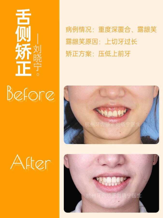 杭州牙齿矫正丨露龈笑怎么办？全面告别露龈笑的4大方法